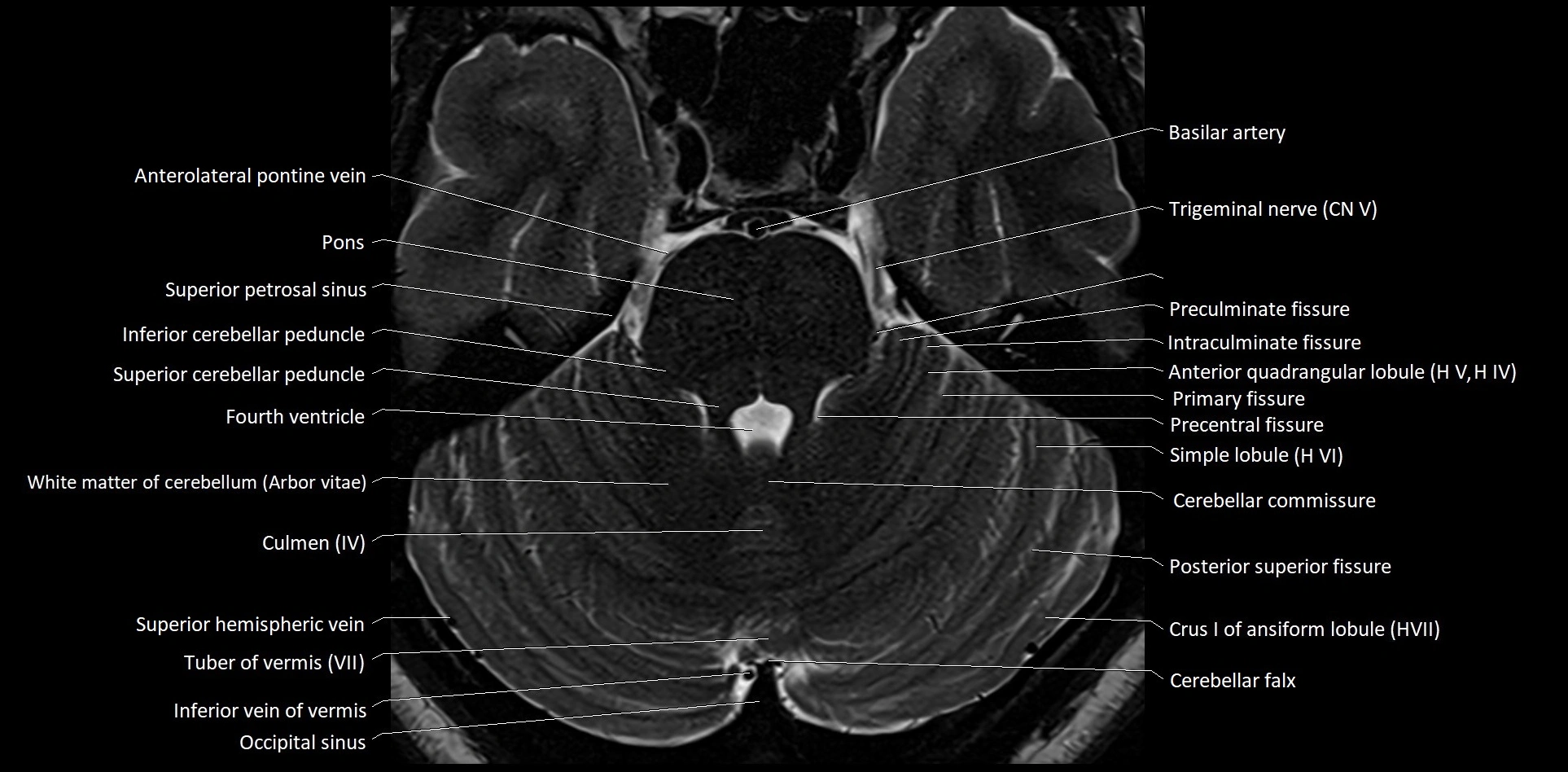 MRI Cerebellar anatomy High-resolution labelled 3T MRI image 17.webp